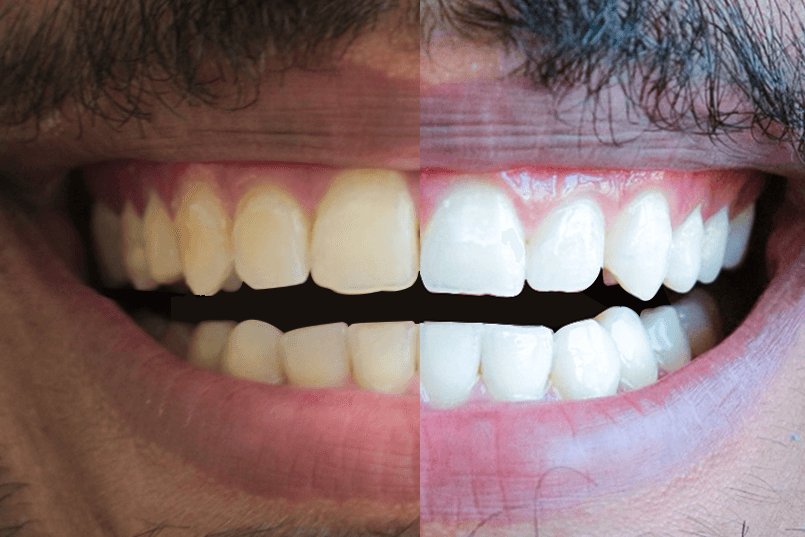 Ilustrar o resultado possível alcançável com o Protocolo de Clareamento dental Realizado com Segurança pela Dentista Mariana Morato