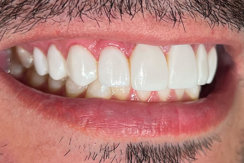 Essa foto reflete um paciente sorrindo exibindo suas Facetas em Resina, cujo resultado se compara também com Lentes de Contato em Porcelana. O procedimento foi realizado pela Dentista Mariana Morato de Belo Horizonte.