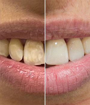 A foto descreve o resultado de uma aplicação de Facetas Dentárias, onde: ao lado esquerdo apresenta os dentes que não refletiam o cuidado bucal que a paciente tinha, e agora ao lado direito a imagem com as facetas aplicadas que imprime o cuidado que condiz com a paciente.