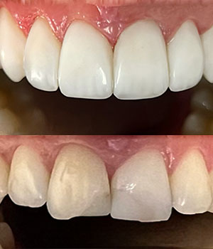 Paciente Rafael de 32 anos, morador de Belo Horizonte. Em uma montagem com o intuito de comparação, é exibido na imagem de cima a reconstrução do sorriso de Rafael após aplicar as Facetas Dentais. Procedimento executado pela Dentista Mariana Morato de Belo Horizonte - Minas Gerais.