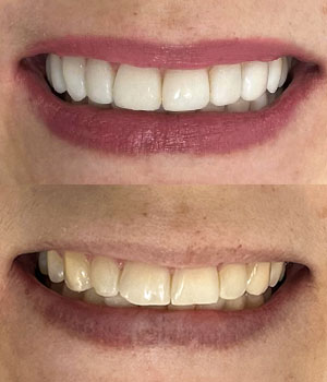 Uma dualidade, onde na imagem acima reflete o sorriso transformado e na de baixo o sorriso antes da transformação. O sorriso acima exibi o procedimento de uma Reconstrução Oral causado por um desgaste ou uma quebra.
